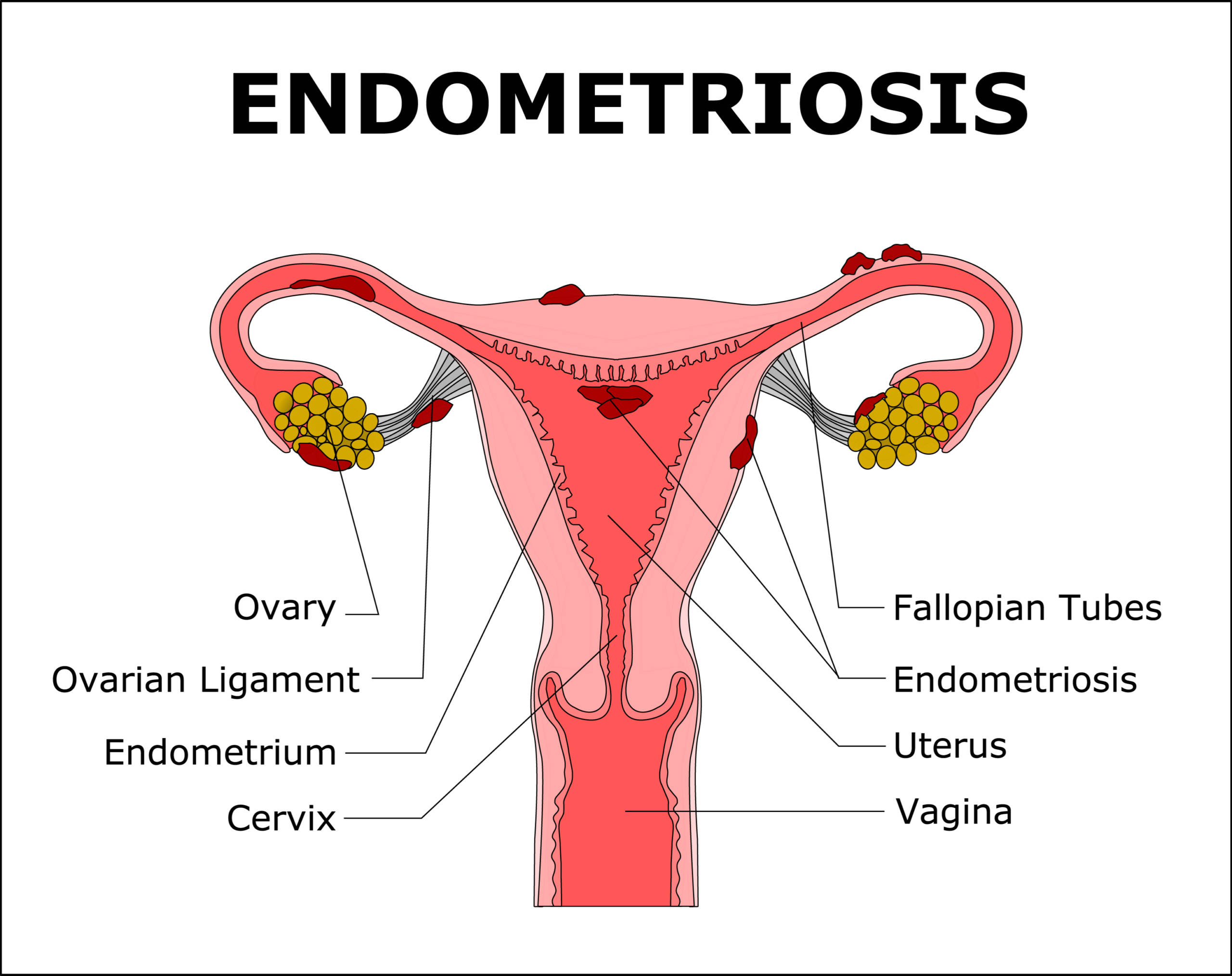 endometriosis endometriosis