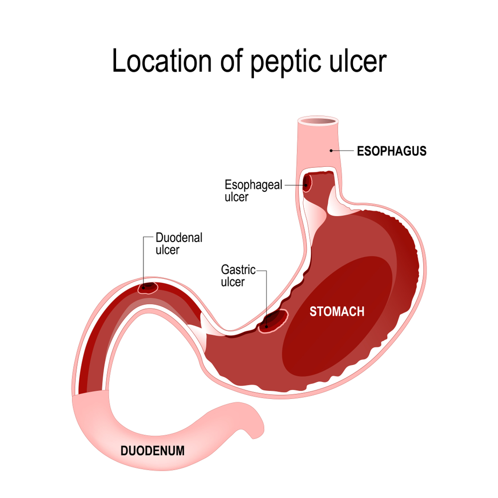 Peptic ulcers often develop due to bacteria infection