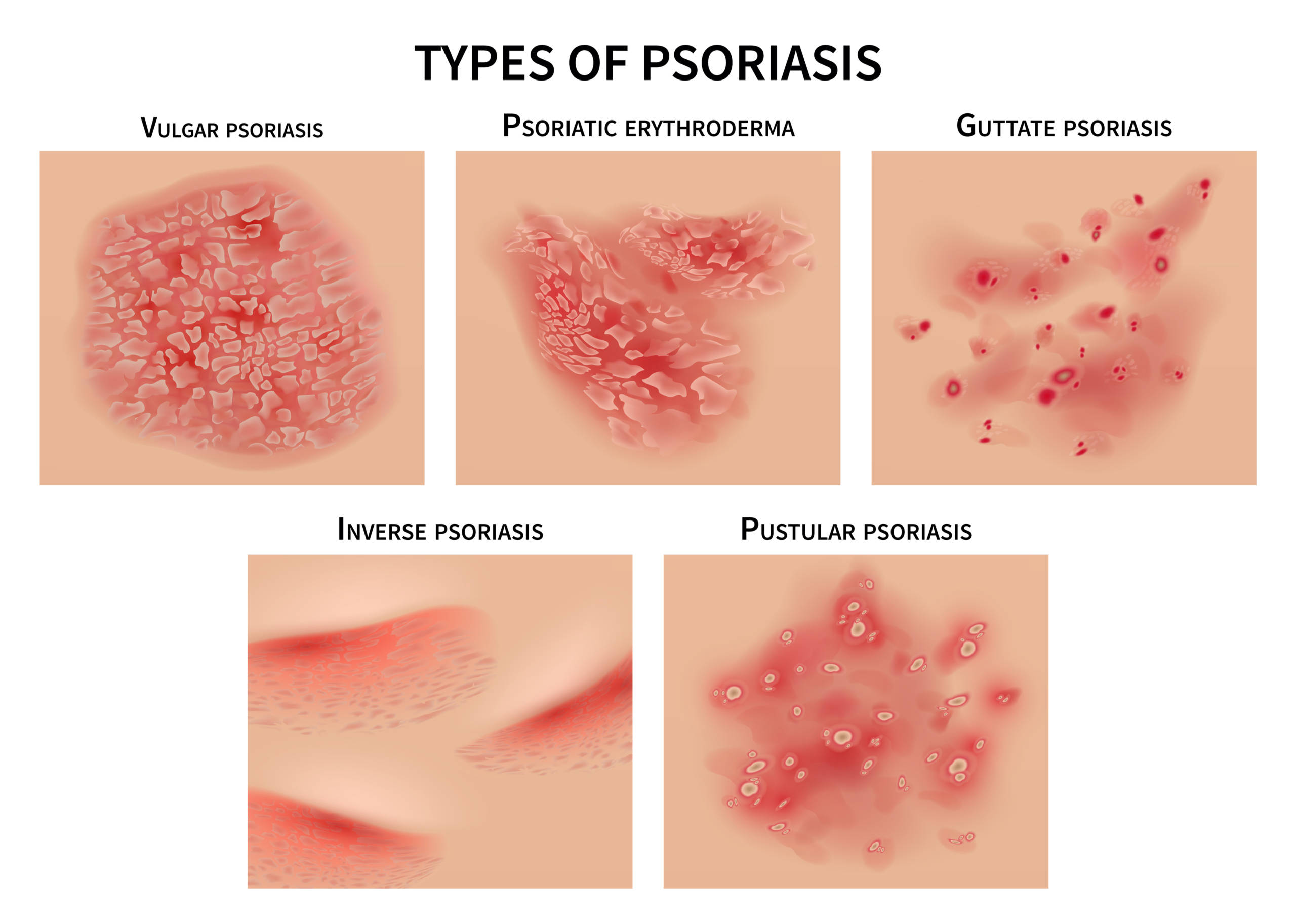 guttate psoriasis vs plaque psoriasis)